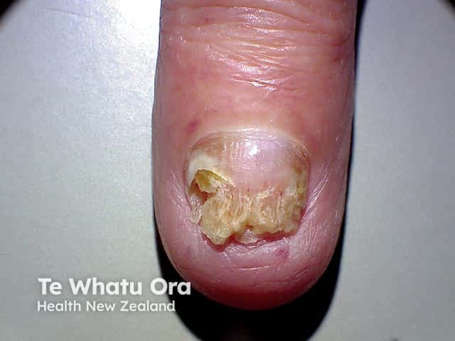 Distal and lateral onychomycosis with subungal hyperkeratosis and crumbling of the entire distal nail plate