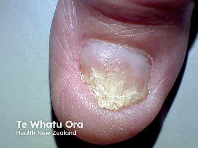 Distal onychomycosis with thickening, crumbling and opacity of the distal plate
