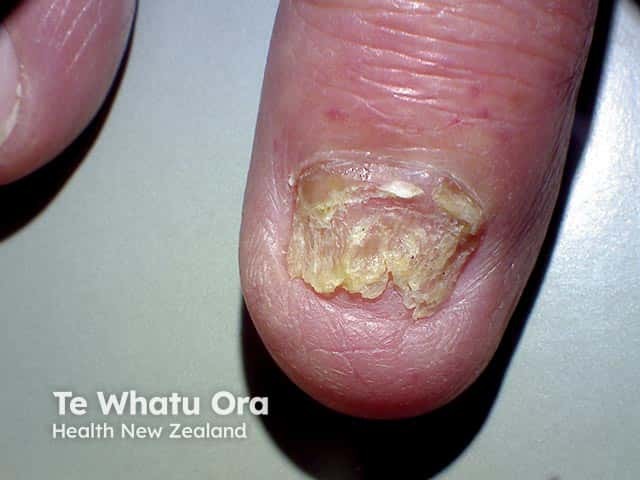 Total onychomycosis with crumbling, opacity and thickening of most of the plate
