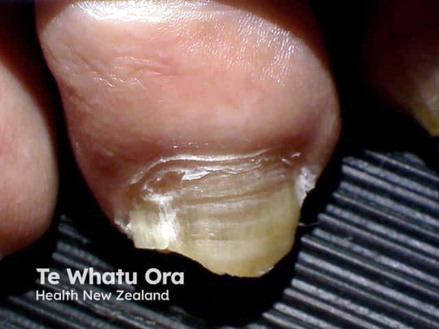 Lateral onychomycosis of a toe nail