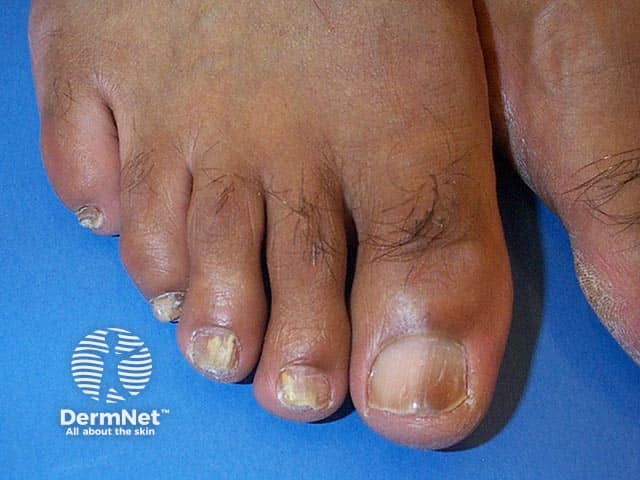 Distal and lateral onychomycosis of several nails