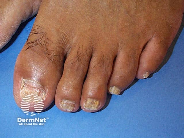 Total onychomycosis of all of the toe nails