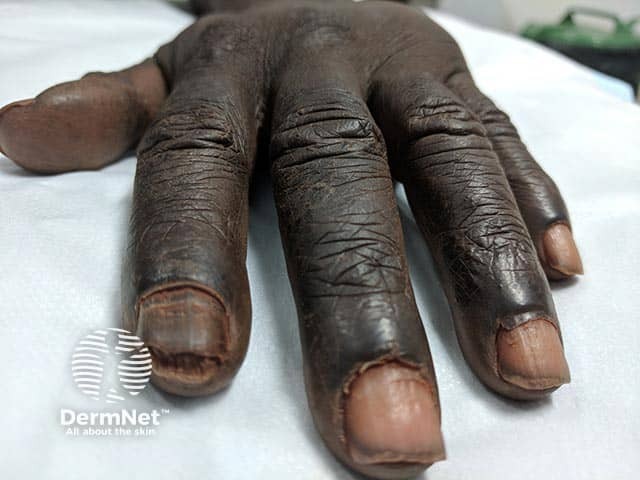 Onychomycosis showing pigmentation of the plate and subungal hyperkeratosis