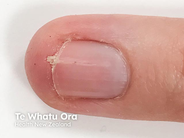 An onychopapilloma of a fingernail - note the longitudinal line and the projecting subungual spicule