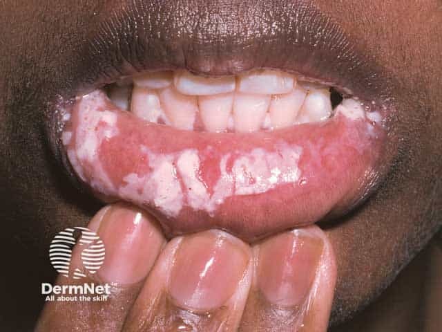 Severe oral candidiasis in HIV infection