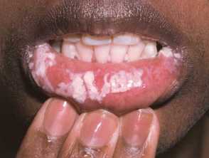 hiv bumps on tongue