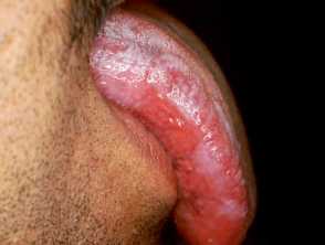 Oral hairy leukoplakia