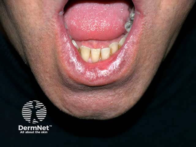 Reticulate and violaceous lichen planus on the lower lip