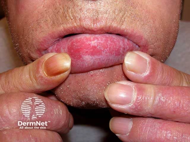 Reticulate and eroded lichen planus on the lower lip