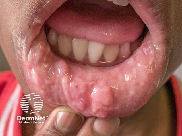 Florid oral warts in HIV disease