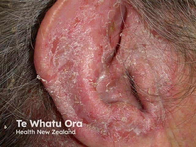 An eczematous otitis externa - the patient had also extensive scalp seborrhoeic dermatitis