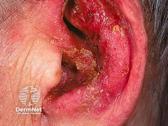 Severe otitis externa