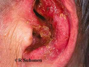 otitis externa maligna pseudomonas