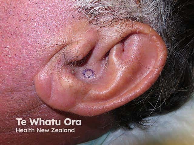 Chronic otitis externa