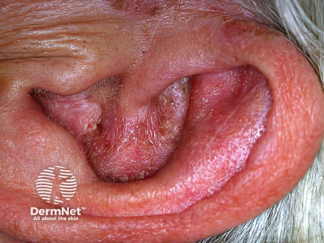 Redness, oedema, and scale due to otitis externa