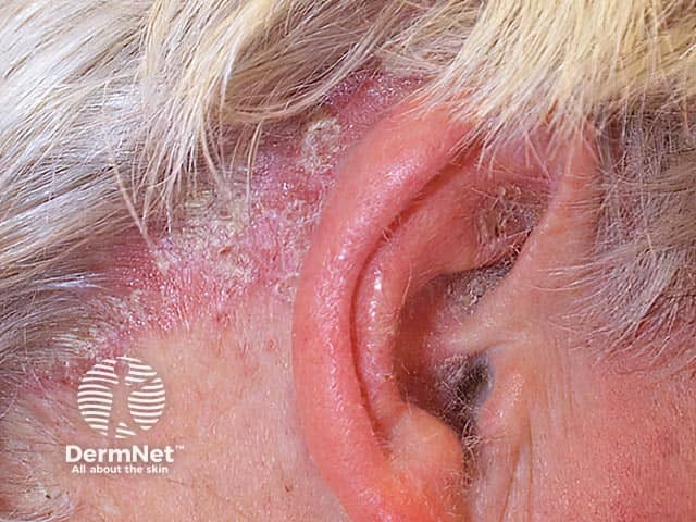 Otitis externa - with the scalp changes, psoriasis is the likley cause