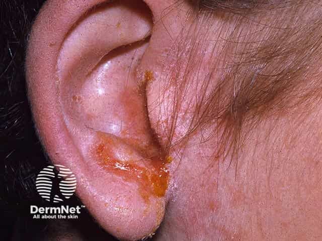 Impetiginised otitis externa - note the honey-coloured exudate