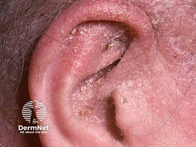 Dry, scaly chronic otitis externa