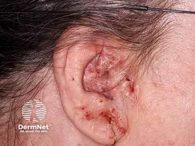 Chronic excoriated otitis externa