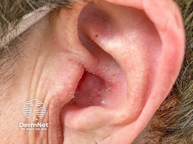 Redness and scaling in the chonchal bowl and auditory canal due to otitis externa