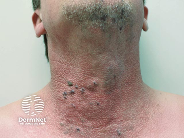 Venous malformations over the neck and chin in PIK3CA gene mutation