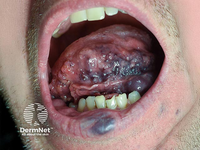 Venous malformations on the tongue and lip in PIK3CA mutation