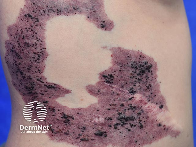 A mixed capillary, venous and lymphatic malformation on the chest in PIK3CA mutation