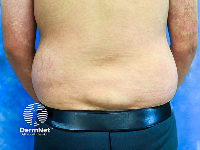 A lipoma on the back in PIK3CA mutation