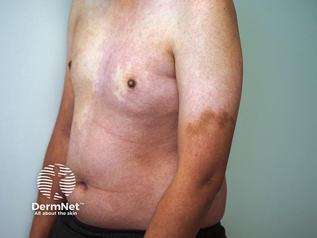 A capillary malformation on the chest and epidermlal naevus on the arm in PIK3CA mutation