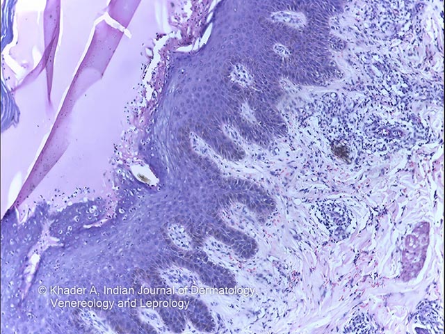 Histology from a peeling area showing subcorneal separation with neutrophils and epidermal acanthosis with a perivascular neutrophilic infiltrate