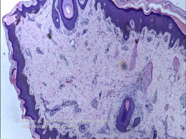 Biopsy from a finger hyperkeratotic papule showing hyperkeratosis, irregular acanthosis, and a perifollicular and perivascular neutrophilic infiltrate
