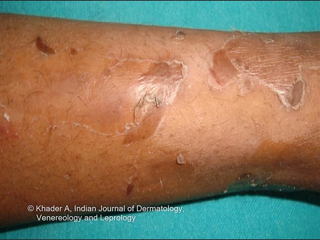 The peeling skin seen in PLACK syndrome (courtesy of Dr AS Vidya, Kerala, India)