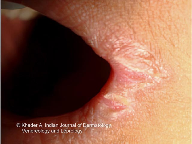 Angular cheilitis seen in PLACK syndrome