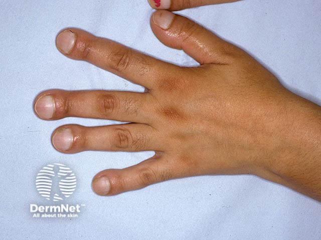 Gross clubbing and swelling of the wrists in pachydermoperiostosis - there was also marked hyperhidrosis