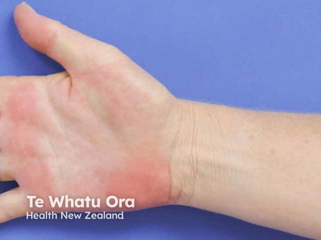 Palmar erythema