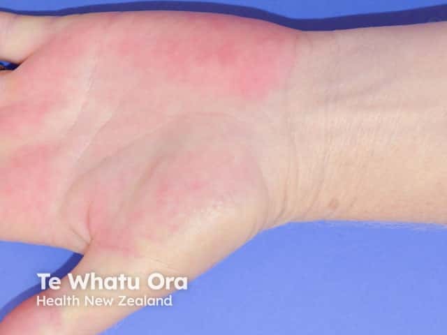 Erythema Hands