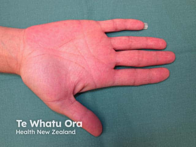 Palmar erythema