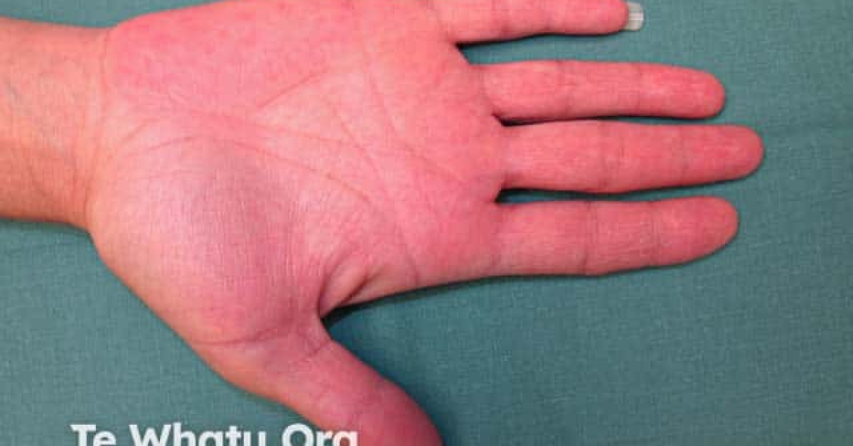 Palmar erythema image