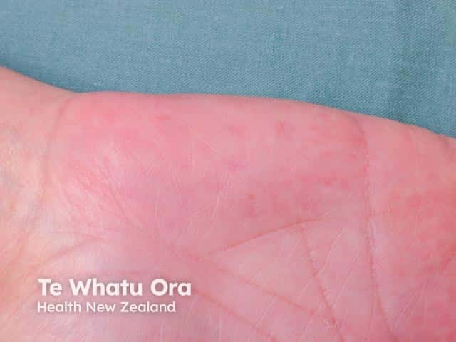 Palmar erythema