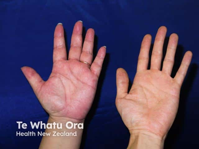 Palmar erythema hereditarium in daughter and mother