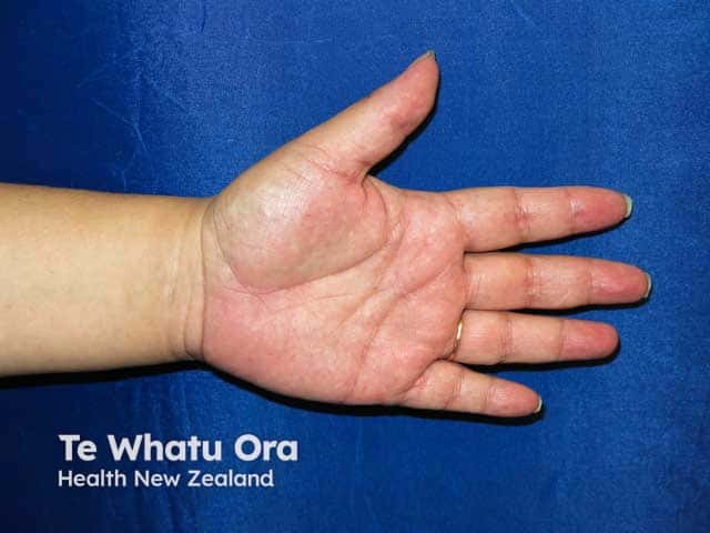 Palmar erythema in pregnancy