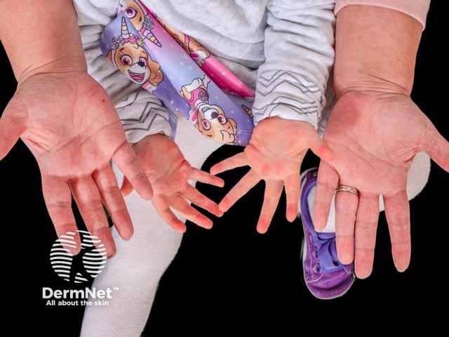 Palmar erythema in mother and daughter
