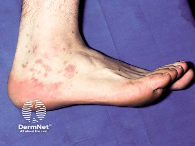 Lichen planus over the ankle and heel
