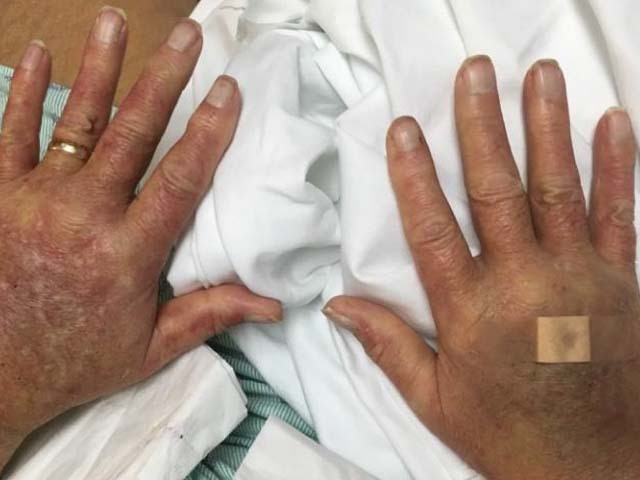 Papular purpuric gloves and socks syndrome: EBV