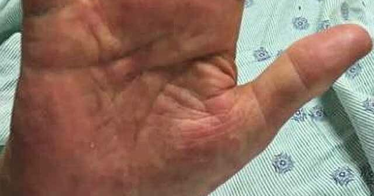 Papular purpuric gloves and socks syndrome image