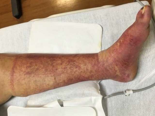Papular purpuric gloves and socks syndrome: EBV