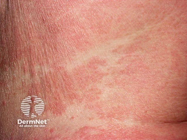 Bands of 'deck chair' sparing on the abdomen in papuloerythroderma