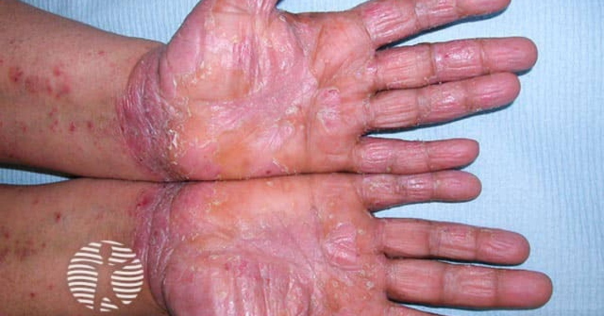 Paradoxical psoriasis image