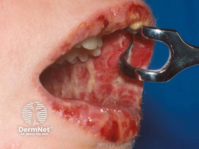 Severe oral paraneoplastic pemphigus due to an underlying Castleman tumour
