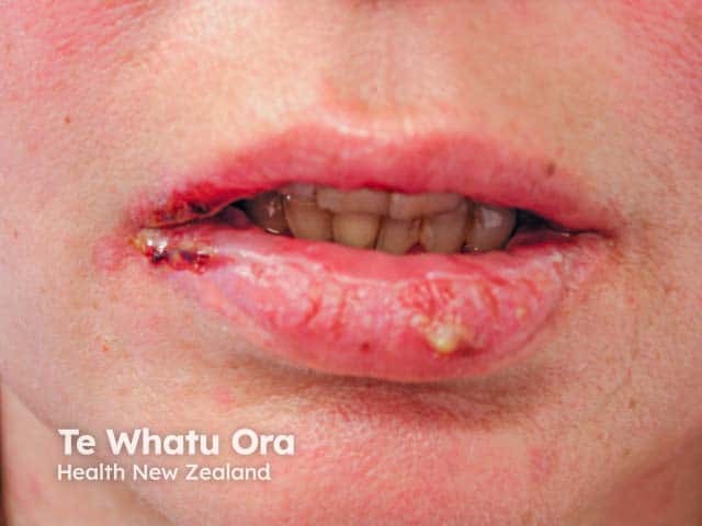 Lip erosions in paraneoplastic pemphigus